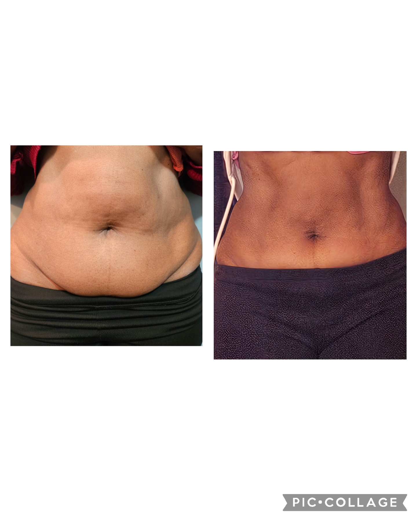 Emsculpt NEO Results 8